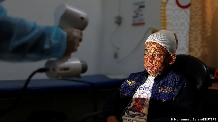 Palästina Brandopfer aus Gaza erhalten 3D-gedruckte Gesichtsmasken