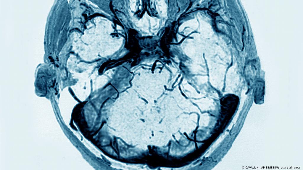 Γιατί προκαλεί εγκεφαλικές θρομβώσεις το AstraZeneca? | Περιβάλλον &  Επιστήμη | DW | 19.03.2021