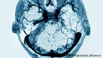 Тромбоз синуса левой части головного мозга на КТ