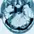 МРТ-знімок: тромбоз церебральних венозних синусів