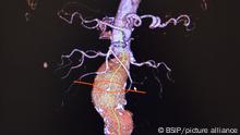 Reportage in the Cardiology Department of Lille hospital, France. Hybrid cardiac surgery operating theatre equipped with the Discovery IGS 730 imaging system. Treatment of a thoraco-abdominal aortic aneurysm (celiac artery) by endovascular means by Profes