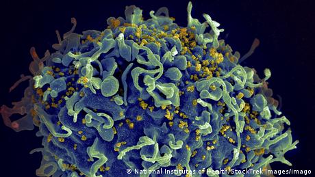 HIV, the virus that can cause AIDS, under a microscope