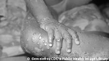 Human infection with monkeypox-like virus in 4 year-old female in Bondua, Grand Gedeh County, Liberia. This infection was caused by a pox virus of the vaccinia, variola, monkeypox type.
Date	1971