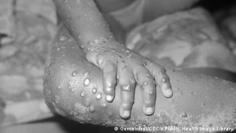 Випадки зараження людей мавпячою віспою відомі з 1970 року - на цьому фото інфікована дитина в Ліберії