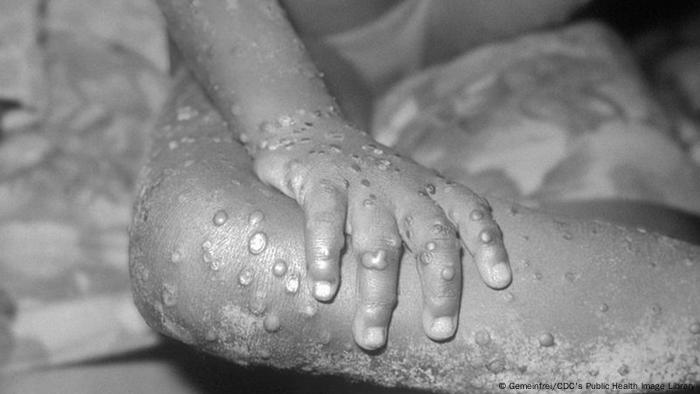 A child with blistered skin resulting from a human monkeypox infection.