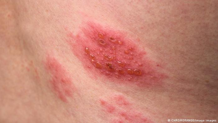 Manifestación del herpes zóster, conocido como culebrilla, una molesta enfermedad que ataca las células nerviosas