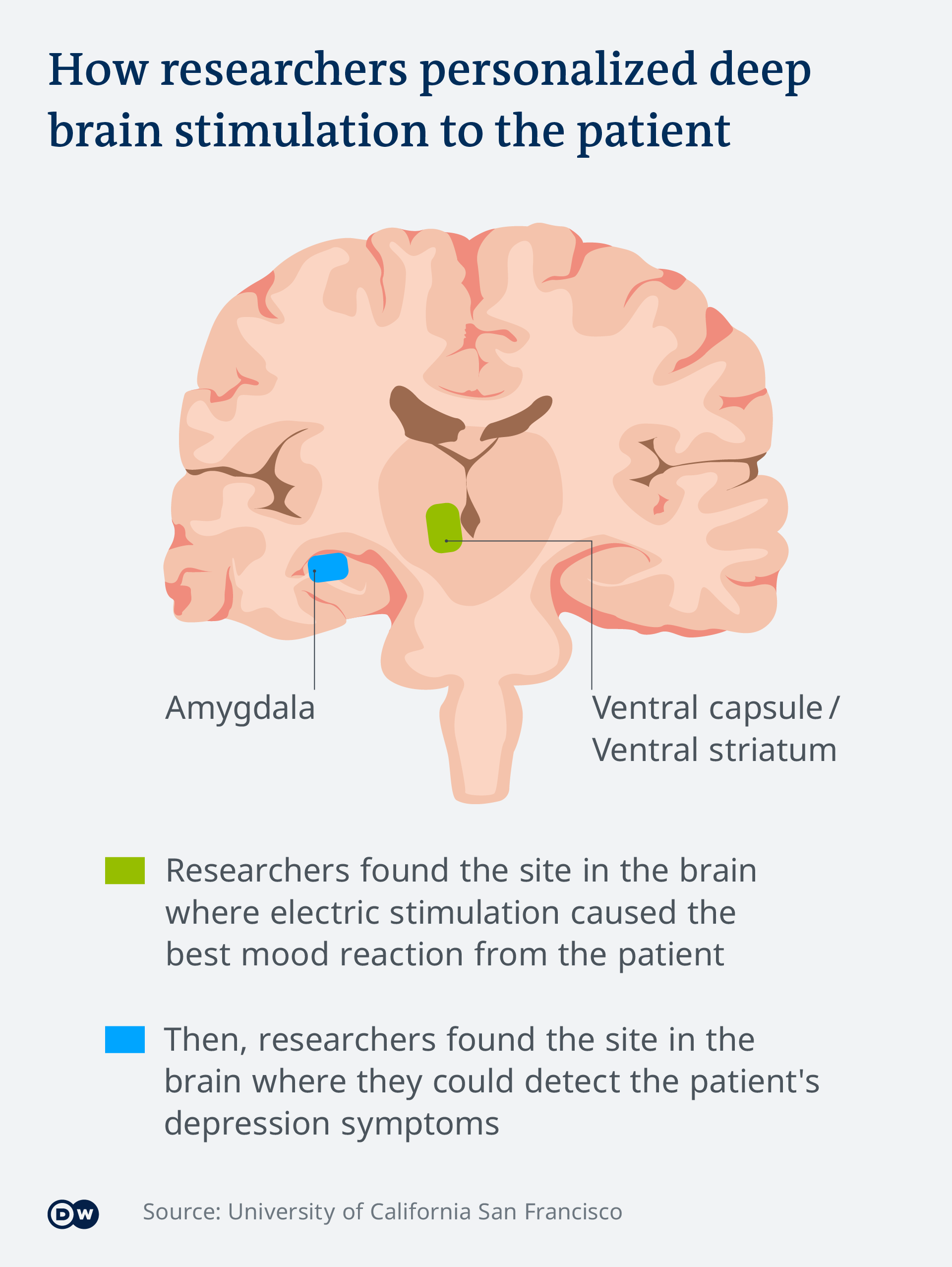 An infographic explaining that researchers first found the site in the brain where electric stimulation caused the best mood reaction from the patient (the ventral capsule) and then pinpointed the site in the brain where they could detect the patient's depression symptoms (the amygdala) An infographic explaining that researchers first found the site in the brain where electric stimulation caused the best mood reaction from the patient (the ventral capsule) and then pinpointed the site in the brain where they could detect the patient's depression symptoms (the amygdala)