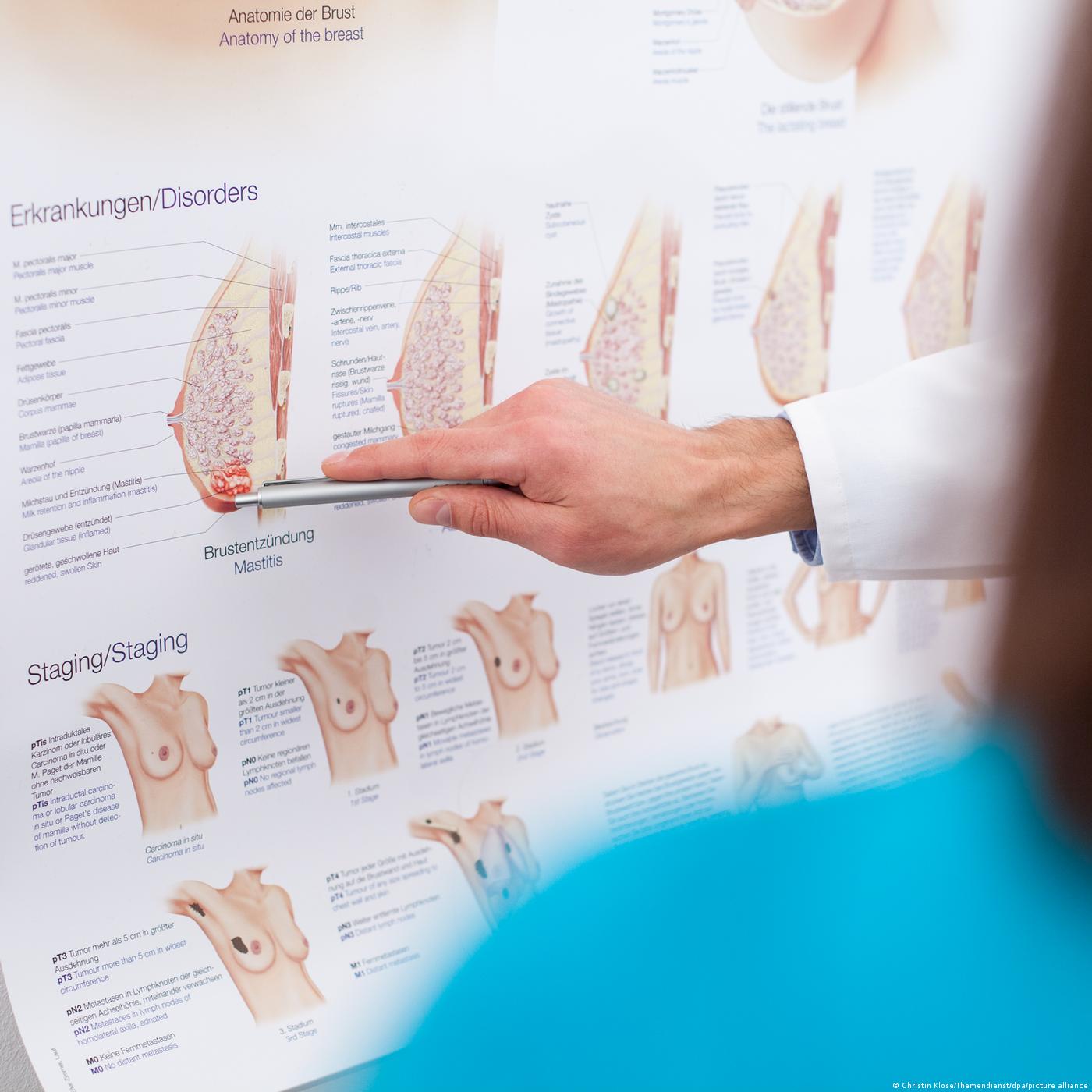 Cancer du sein : ce qu'il faut savoir