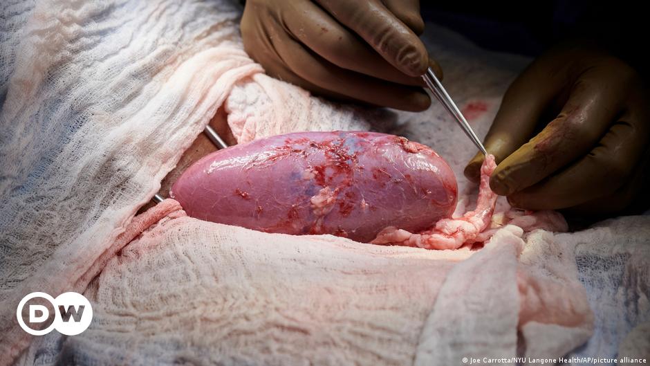 Erste Nieren-Transplantation vom Schwein zum Menschen gelungen  