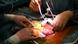 Nieren Nierentransplantation Niere Operation Nieren Nierentransplantation Niere Operation
