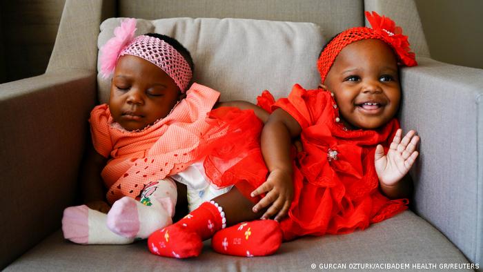Türkei Istanbul | Zusammengewachsene kamerunische Zwillinge erfolgreich getrennt