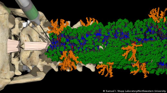 Una nueva terapia inyectable forma nanofibras con dos señales bioactivas diferentes (verde y naranja) que se comunican con las células para iniciar la reparación de la médula espinal lesionada. Ilustración de Mark Seniw.