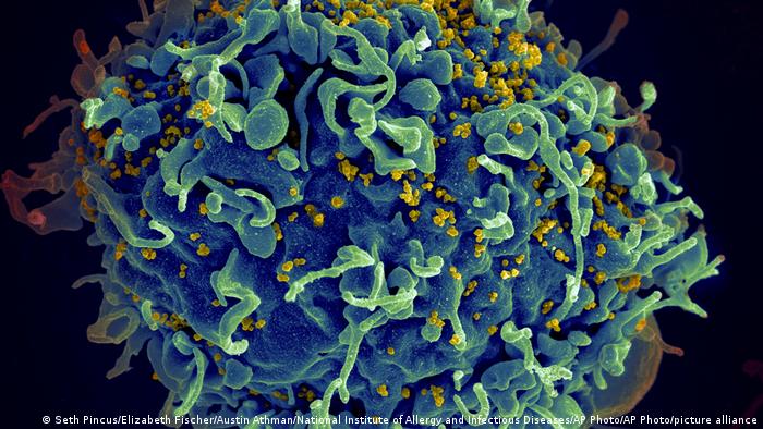 Electron microscope image of a T-cell attacked by HIV