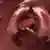 صورة بالكمبيوتر تظهر ورماً سرطانياً خبيثاً في أسفل القولون 