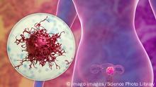 Uterine cancer, illustration Uterine cancer. Computer illustration showing a cancerous tumour in the uterus and a close-up view of a cancer cell. *** Uterine cancer, illustration Uterine cancer Computer illustration showing a cancerous tumour in the uterus and a close up view of a cancer cell PUBLICATIONxINxGERxSUIxHUNxONLY KATERYNAxKON/SCIENCExPHOTOxLIBRARY F032/6075