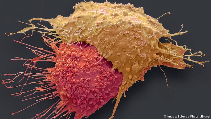 Electron microscopic image of ovarian cancer cells 