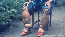 Elephantiasis of leg due to filariasis. Luzon, Philippines.