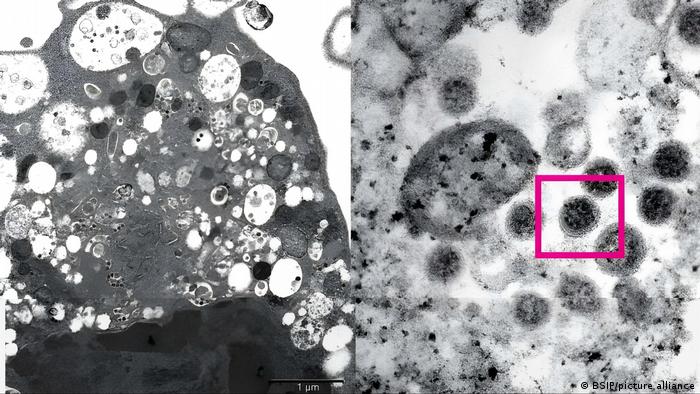 Micrografía de una célula de riñón de mono (Vero E6) tras la infección con la variante ómicron del SARS-CoV-2 que muestra el daño celular con vesículas hinchadas que contienen pequeñas partículas virales negras y a la derecha.
