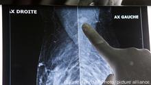 Dr. Abdoul Aziz Kasse looks at a mammogram that shows signs of cancer in his office at the Clinique des Mamelles in Dakar, Senegal, Thursday, July 13, 2017. The word cancer is rarely spoken in Senegal, synonymous with death in a country where many are only diagnosed in the later stages of disease and radiation therapy can be difficult to access. Cancer has become an emerging public health problem in West Africa, and the lack of strong prevention, good screening and treatment often leaves outcomes grim. (AP Photo/Jane Hahn)
