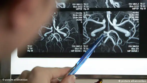 Arzt untersucht Röntgenaufnahme der Gehirnarterien (Foto: dpa)