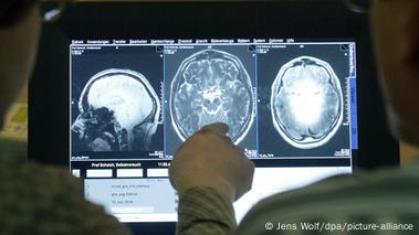 Alzheimer's disease: Mystery of dying brain cells solved – DW – 09/21/2023