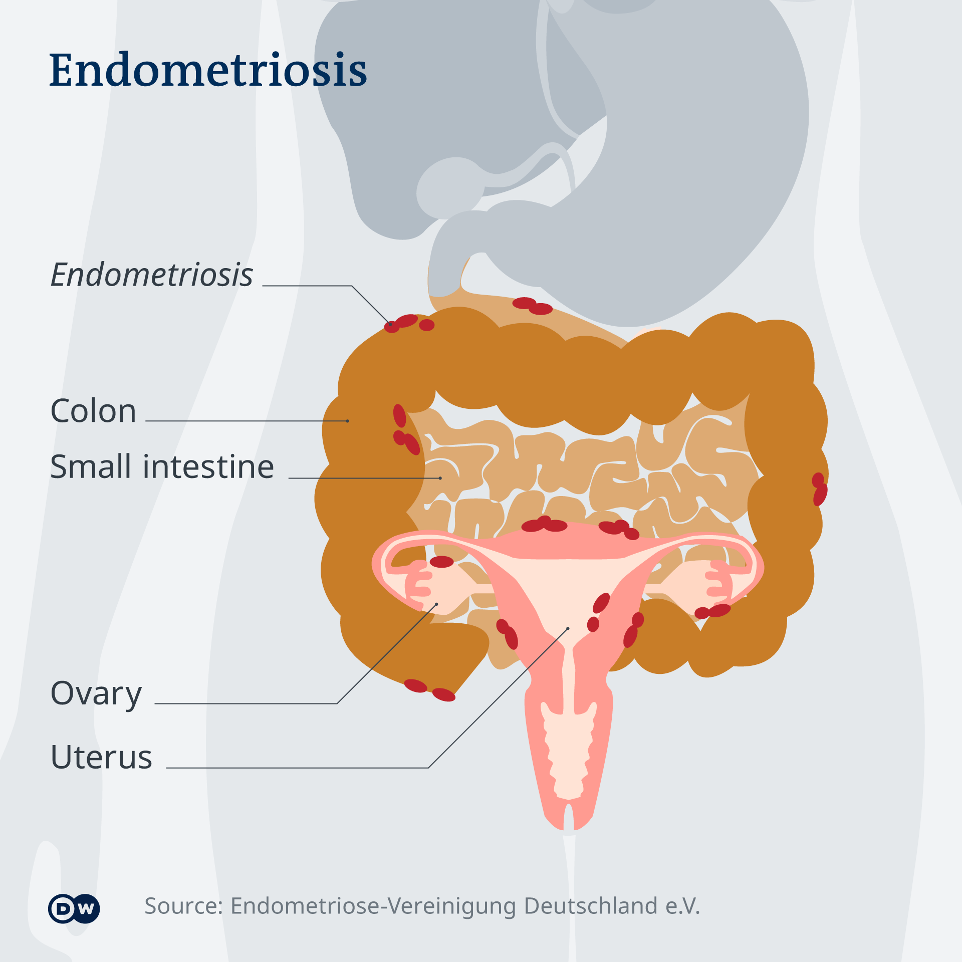 An infographic showing how endometriosis presents in a female's colon, small intestine, ovaries and uterus