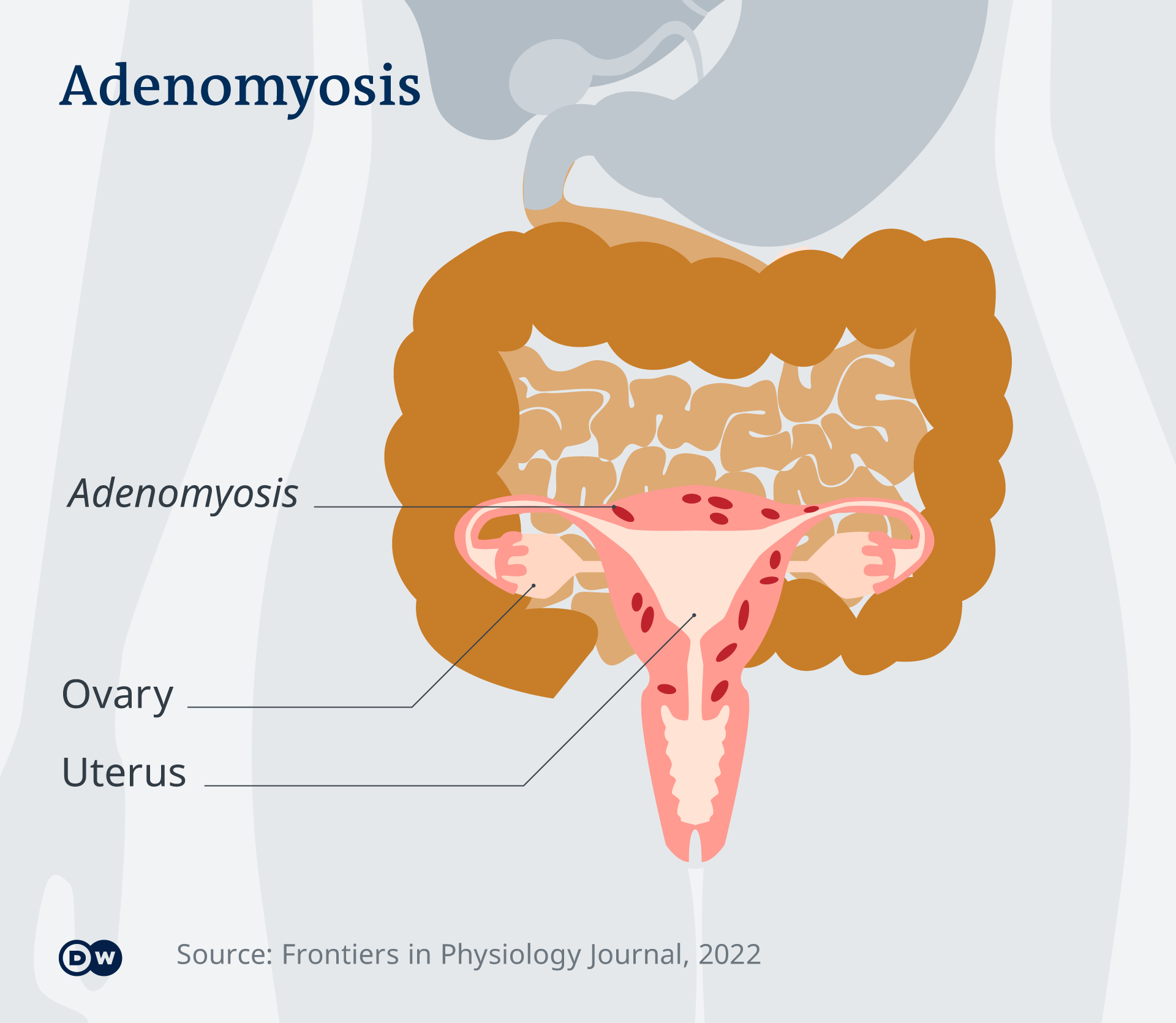 An infographic showing how adenomyosis presents in a female's ovaries and uterus