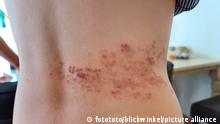 Guertelrose am Ruecken | shingles rash on the rear