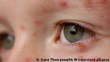 Chicken pox.STOCK. A child with chicken pox. Picture date: Tuesday May 26, 2009. Photo credit should read: Dave Thompson/PA Wire URN:7347577