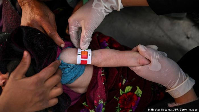 Empleados de Médicos Sin Fronteras miden el brazo de un niño para detectar el grado de malnutrición.