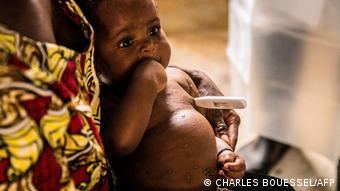 Ребенок с оспой обезьян в Центрально-Африканской Республике