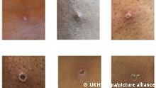 Das von der UK Health Security Agency (UKHSA) zur Verfügung gestellte Bild zeigt Hautläsionen bei Patienten, bei denen Affenpocken nachgewiesen wurden (Bestmögliche Bildqualität). In Großbritannien sind zwei weitere Fälle von Affenpocken erfasst worden. (zu dpa Zwei weitere Fälle von Affenpocken in Großbritannien bestätigt) +++ dpa-Bildfunk +++