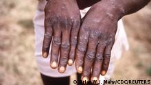 An image created during an investigation into an outbreak of monkeypox, which took place in the Democratic Republic of the Congo (DRC), 1996 to 1997, shows the hands of a patient with a rash due to monkeypox, in this undated image obtained by Reuters on May 18, 2022. CDC/Brian W.J. Mahy/Handout via REUTERS THIS IMAGE HAS BEEN SUPPLIED BY A THIRD PARTY.