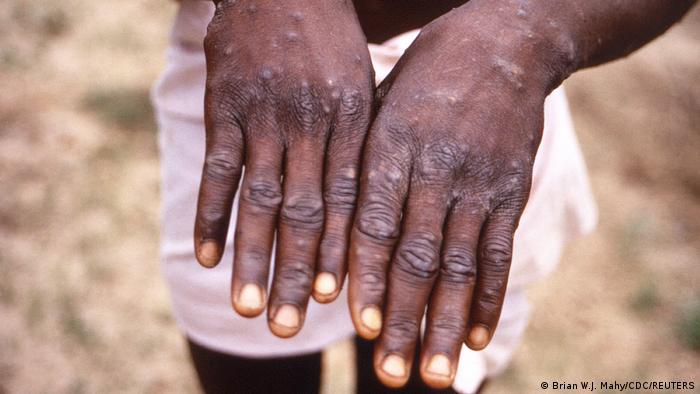Erupción por viruela del mono en las manos de un paciente africano.