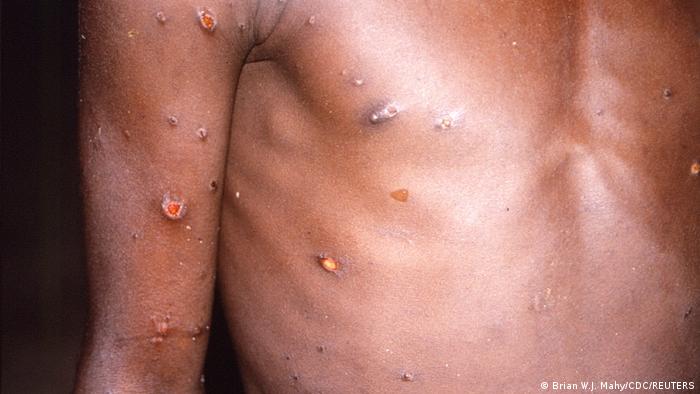 One of the symptoms of monkey pox
