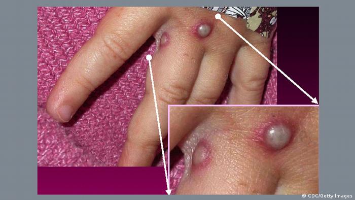 Síntoma de la viruela del mono: las pústulas con secreción.