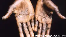 The palms of a monkeypox case patient from Lodja, a city located within the Katako-Kombe Health Zone, are seen during a health investigation in the Democratic Republic of Congo in 1997. Picture taken in 1997. Brian W.J. Mahy/CDC/Handout via REUTERS.
THIS IMAGE HAS BEEN SUPPLIED BY A THIRD PARTY. IT IS DISTRIBUTED, EXACTLY AS RECEIVED BY REUTERS, AS A SERVICE TO CLIENTS