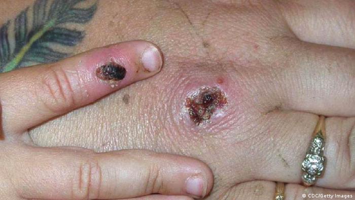 In this Centers for Disease Control and Prevention handout graphic, symptoms of one of the first known cases of the monkeypox virus are shown on a patient's hand June 5, 2003. 