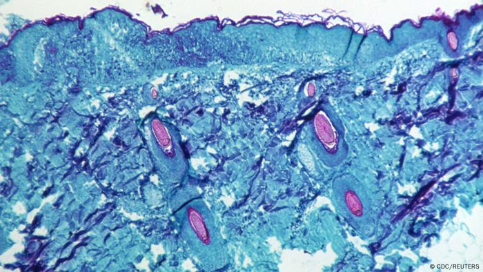 Virus de la viruela del mono.