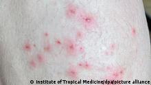 Das vom Institute of Tropical Medicine Antwerp zur Verfügung gestellte Foto zeigt Hautsymptome von Affenpocken-Patienten. (Bestmögliche Bildqualität) Infektionen mit dem Virus werden mittlerweile aus immer mehr Ländern gemeldet. +++ dpa-Bildfunk +++