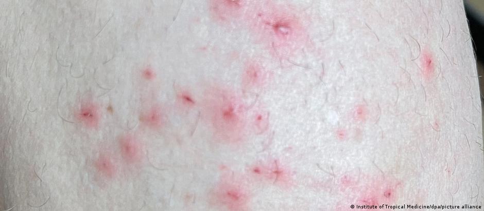 Sintomas da varíola dos macacos em uma imagem fornecida pelo Instituto de Medicina Tropical da Antuérpia