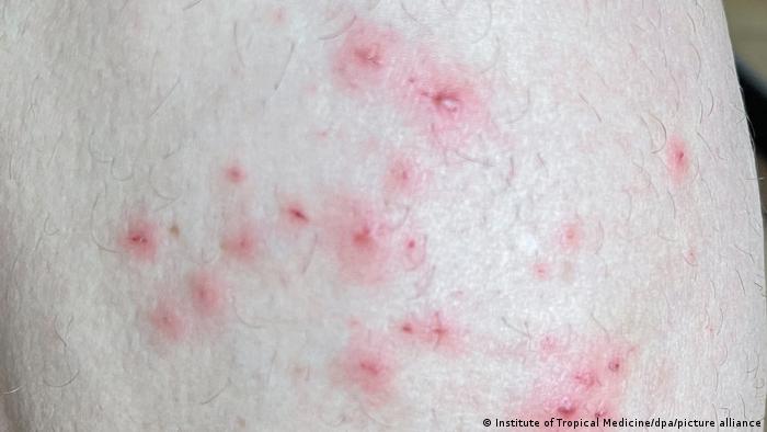 Monkeypox symptoms, like red dots, seen on skin