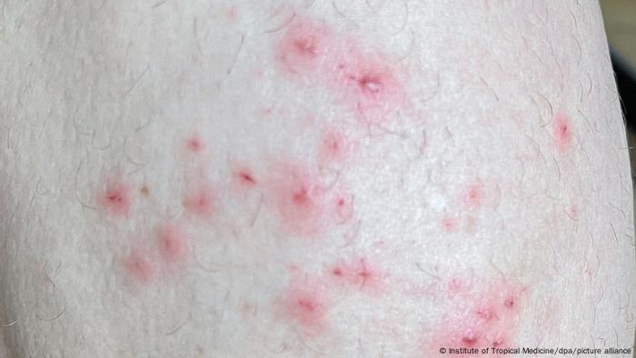 Monkeypox symptoms, like red dots, seen on skin