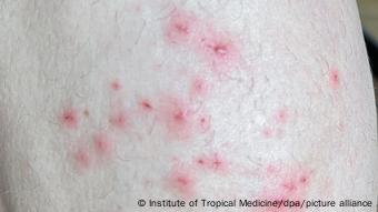 Monkeypox on skin, seen as red dots