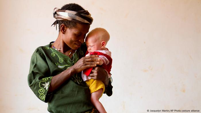 A mother holds an infant with albinism in front of a neutral background