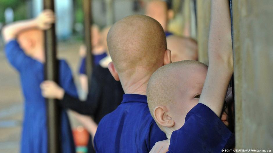 Malawi murder case shines light on anti-albino prejudice in Africa | Africa | DW - Vimarsana News