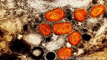 This iamge provided by the National Institute of Allergy and Infectious Diseases (NIAID) shows a colorized transmission electron micrograph of monkeypox particles (orange) found within an infected cell (brown), cultured in the laboratory. This image was captured at the NIAID Integrated Research Facility (IRF) in Fort Detrick, Md. The World Health Organization recently declared the expanding monkeypox outbreak a global emergency. It is WHO’s highest level of alert, but the designation does not necessarily mean a disease is particularly transmissible or lethal. (NIAID via AP)