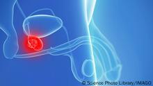 Prostate cancer, artwork Prostate cancer, computer artwork. PUBLICATIONxINxGERxSUIxHUNxONLY SCIEPRO/SCIENCExPHOTOxLIBRARY F006/8087
Cancer Artwork Cancer Computer Artwork PUBLICATIONxINxGERxSUIxHUNxONLY SCIEPRO SCIENCExPHOTOxLIBRARY F006