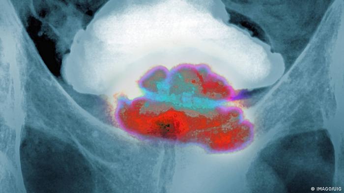 صورة بالأشعة لسرطان البروستاتا