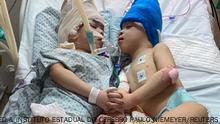 Formerly conjoined twins, Bernardo and Arthur Lima, lie in a hospital bed after a successful separation surgery, in Rio de Janeiro, Brazil July 2022. Gemini Untwined & Instituto Estadual do Cerebro Paulo Niemeyer/Handout via REUTERS THIS IMAGE HAS BEEN SUPPLIED BY A THIRD PARTY. NO RESALES. NO ARCHIVES. MANDATORY CREDIT